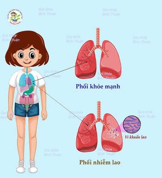 Tuyên truyền về phòng, chống bệnh lao phổi